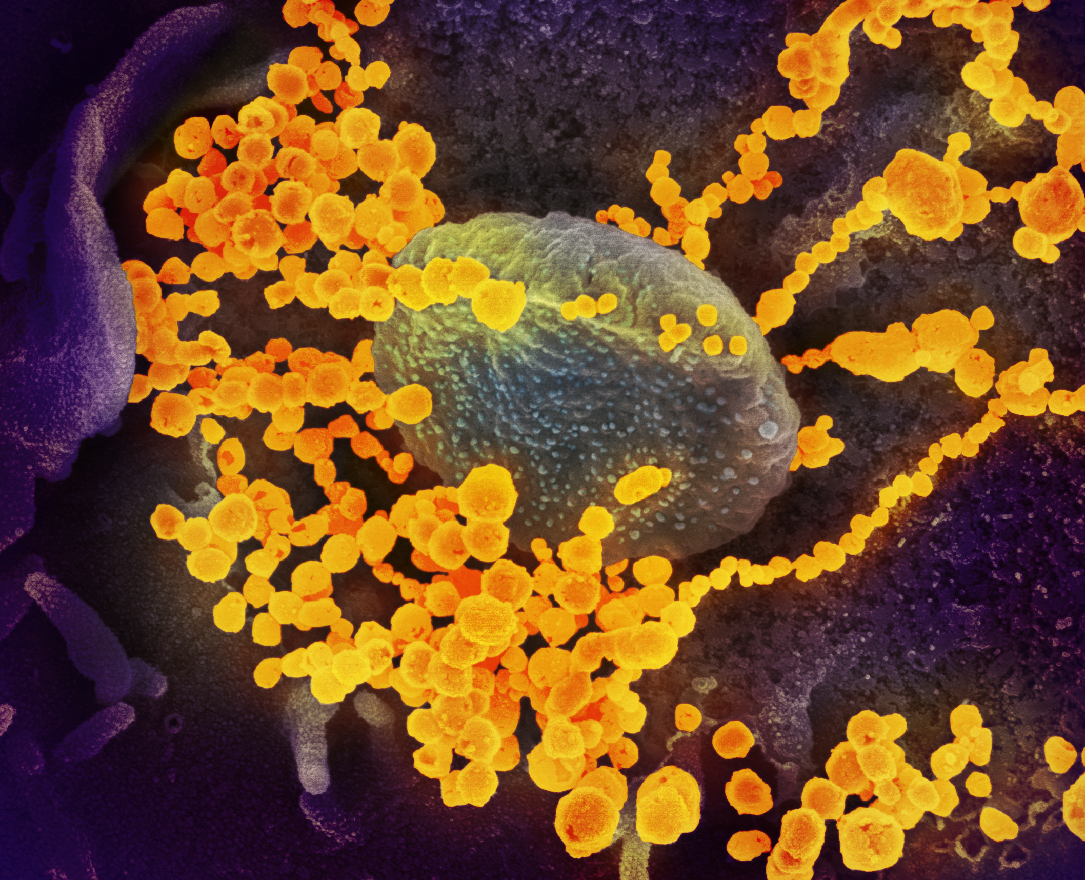 Imagerie par microscope électronique a balayage du SARS-CoV-2, en jaune, émergeant d’une cellule. wikipedia
