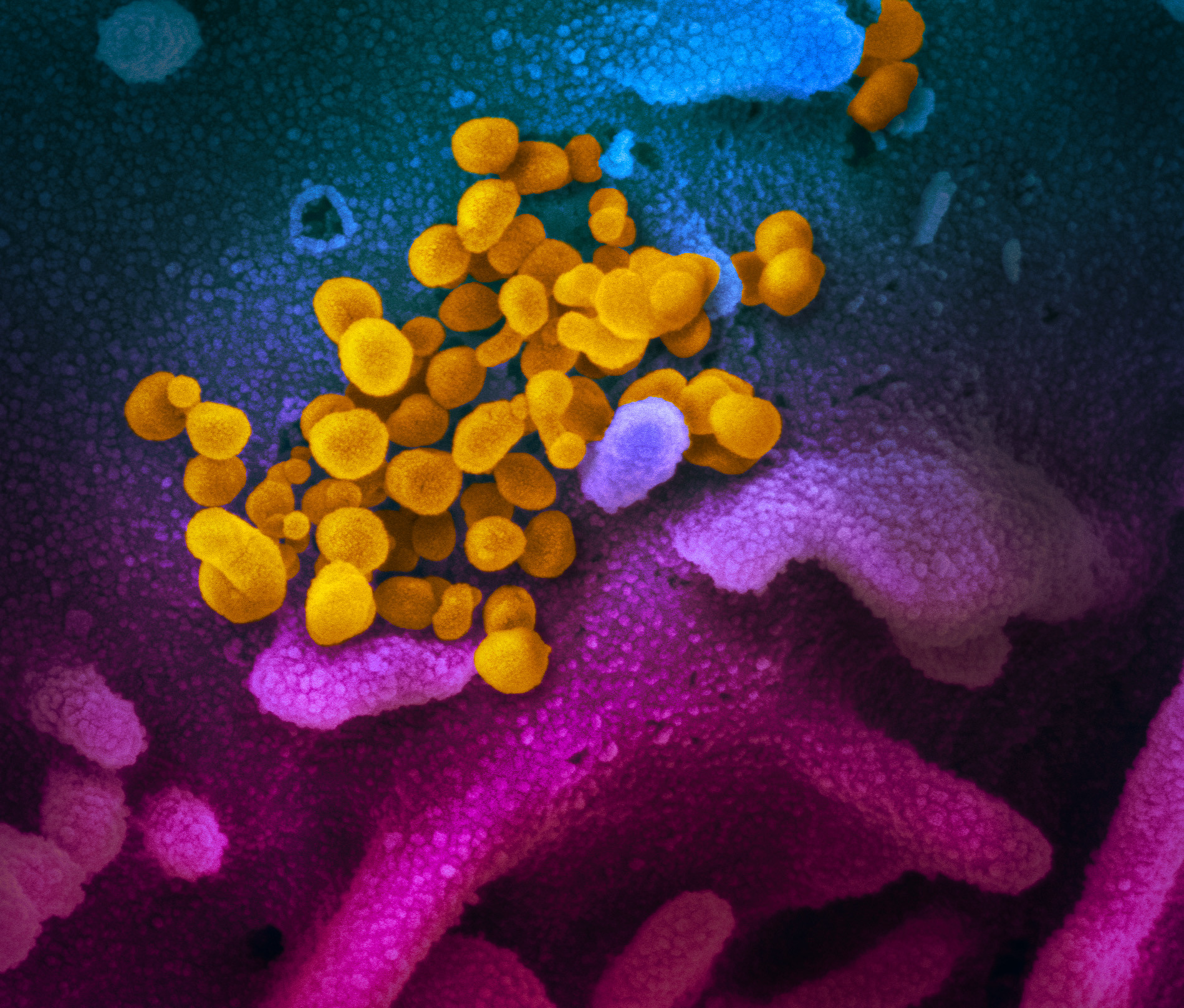 Imagerie par microscope électronique a balayage du SARS-CoV-2, en jaune, émergeant d’une cellule. wikipedia